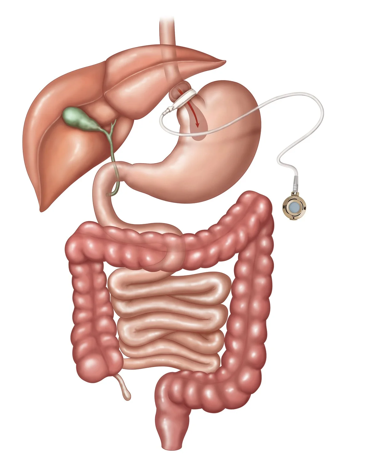 Schlauchmagenchirurgie