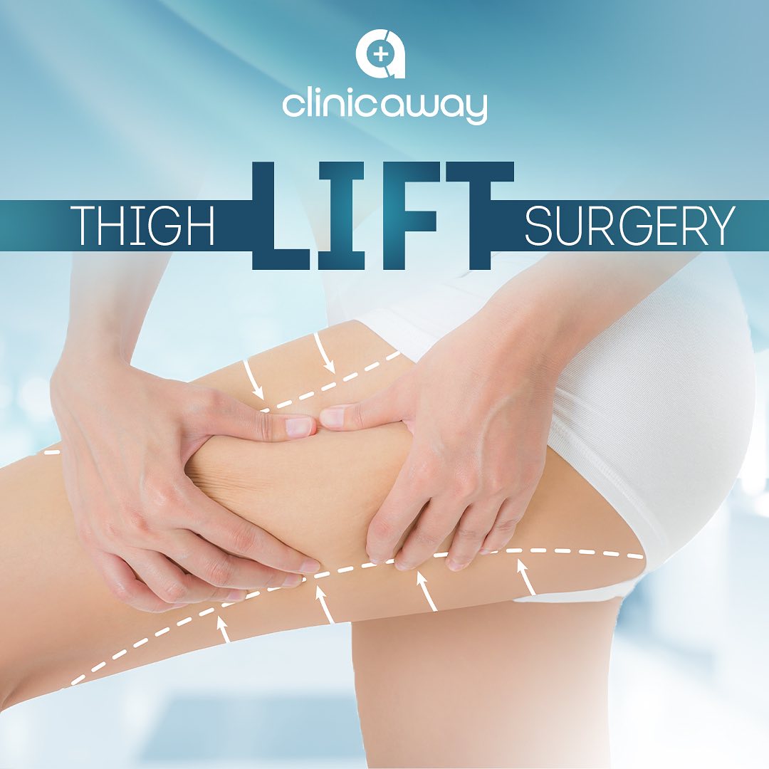 Thigh lift surgery